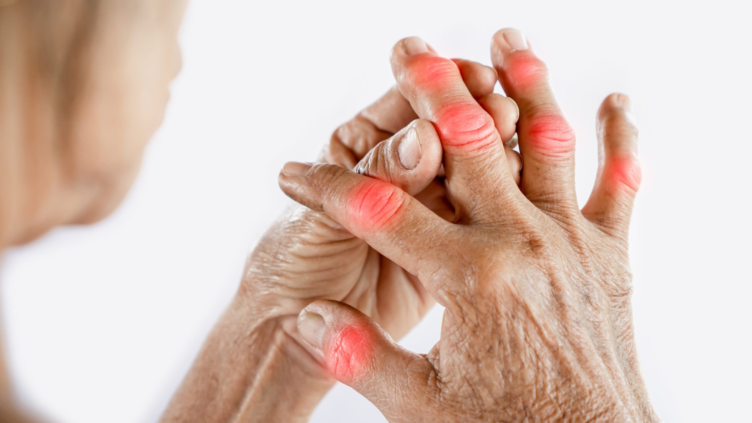 arthritis-the article hub